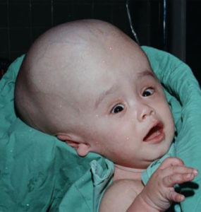 https://www.ispn.guide/hydrocephalus-and-other-anomalies-of-csf-circulation-in-children/