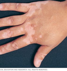 https://www.mayoclinic.org/diseases-conditions/vitiligo/symptoms-causes/syc-20355912
